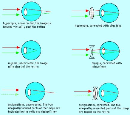 Refraction of light in glasses to correct eye defects